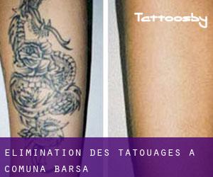 Élimination des tatouages à Comuna Bârsa