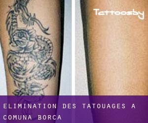 Élimination des tatouages à Comuna Borca
