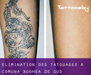 Élimination des tatouages à Comuna Bughea de Sus