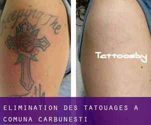 Élimination des tatouages à Comuna Cărbuneşti