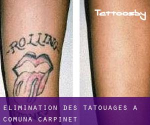 Élimination des tatouages à Comuna Cărpinet