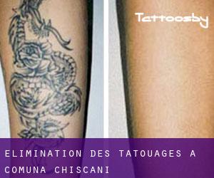 Élimination des tatouages à Comuna Chiscani