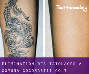 Élimination des tatouages à Comuna Cocorăştii-Colţ