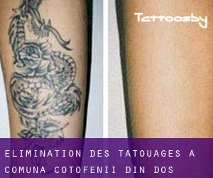 Élimination des tatouages à Comuna Coţofenii din Dos
