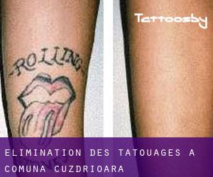 Élimination des tatouages à Comuna Cuzdrioara