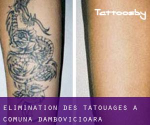 Élimination des tatouages à Comuna Dâmbovicioara
