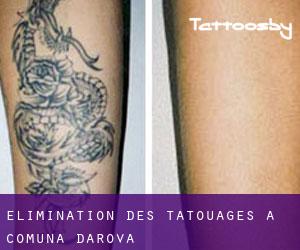 Élimination des tatouages à Comuna Darova