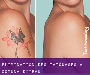 Élimination des tatouages à Comuna Ditrău