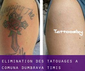 Élimination des tatouages à Comuna Dumbrava (Timiş)