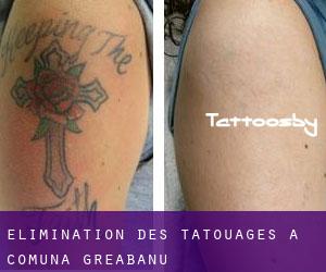 Élimination des tatouages à Comuna Greabănu