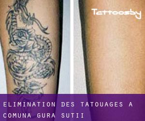 Élimination des tatouages à Comuna Gura Şuţii