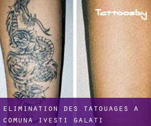 Élimination des tatouages à Comuna Iveşti (Galaţi)