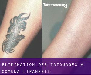 Élimination des tatouages à Comuna Lipăneşti