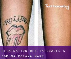Élimination des tatouages à Comuna Poiana Mare