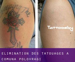 Élimination des tatouages à Comuna Polovragi