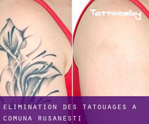 Élimination des tatouages à Comuna Rusăneşti