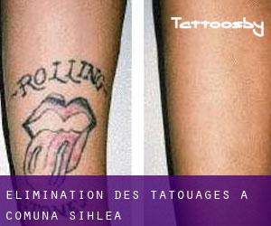Élimination des tatouages à Comuna Sihlea