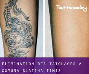 Élimination des tatouages à Comuna Slatina-Timiş