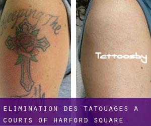 Élimination des tatouages à Courts of Harford Square