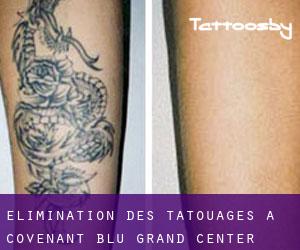 Élimination des tatouages à Covenant Blu-Grand Center