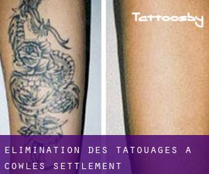 Élimination des tatouages à Cowles Settlement