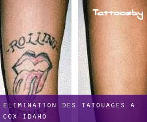 Élimination des tatouages à Cox (Idaho)