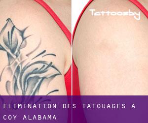 Élimination des tatouages à Coy (Alabama)