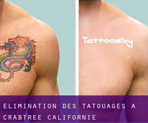 Élimination des tatouages à Crabtree (Californie)