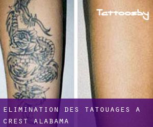 Élimination des tatouages à Crest (Alabama)