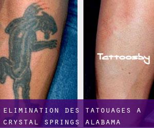 Élimination des tatouages à Crystal Springs (Alabama)