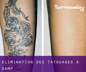 Élimination des tatouages à Damp