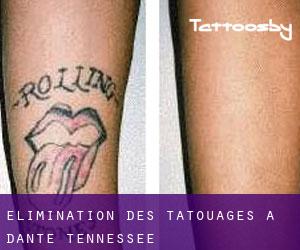 Élimination des tatouages à Dante (Tennessee)