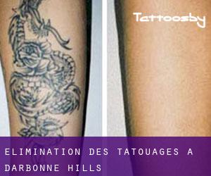 Élimination des tatouages à D'Arbonne Hills