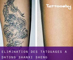 Élimination des tatouages à Datong (Shanxi Sheng)
