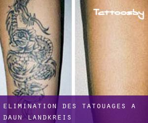 Élimination des tatouages à Daun Landkreis