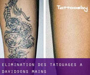 Élimination des tatouages à Davidsons Mains