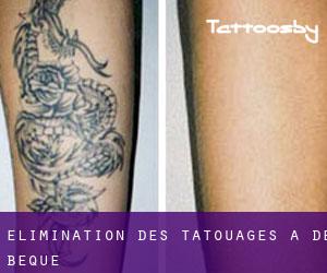 Élimination des tatouages à De Beque