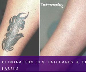 Élimination des tatouages à De Lassus