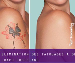 Élimination des tatouages à De Loach (Louisiane)
