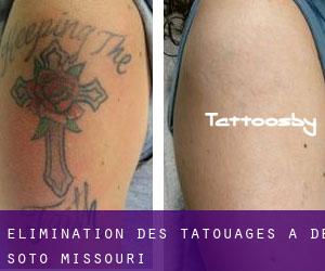 Élimination des tatouages à De Soto (Missouri)