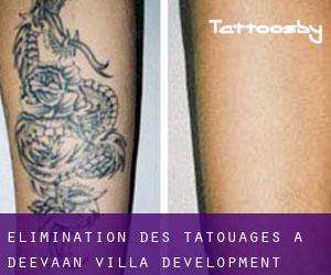 Élimination des tatouages à Deevaan Villa Development