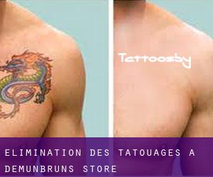 Élimination des tatouages à Demunbruns Store