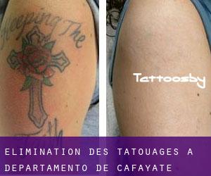 Élimination des tatouages à Departamento de Cafayate
