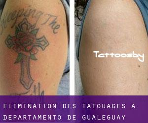 Élimination des tatouages à Departamento de Gualeguay