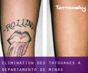 Élimination des tatouages à Departamento de Minas