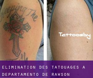 Élimination des tatouages à Departamento de Rawson