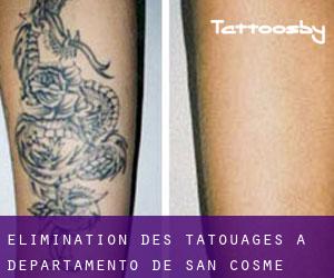 Élimination des tatouages à Departamento de San Cosme