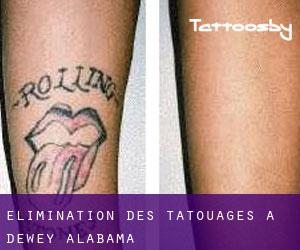 Élimination des tatouages à Dewey (Alabama)