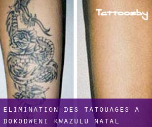 Élimination des tatouages à Dokodweni (KwaZulu-Natal)