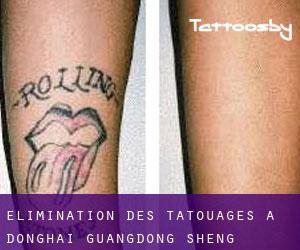 Élimination des tatouages à Donghai (Guangdong Sheng)